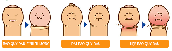 Tìm hiểu cắt bao quy đầu là gì