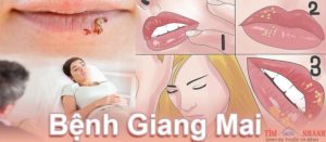 Tìm hiểu về bệnh giang mai