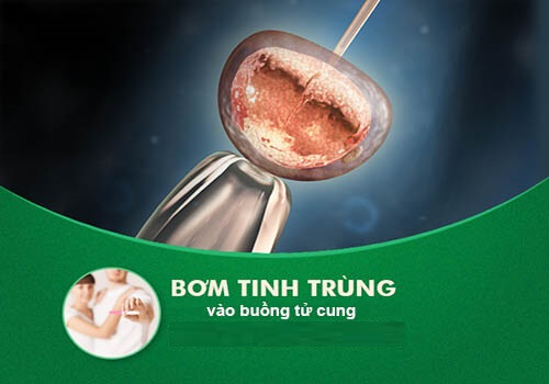 Tìm hiểu về thụ tinh nhân tạo