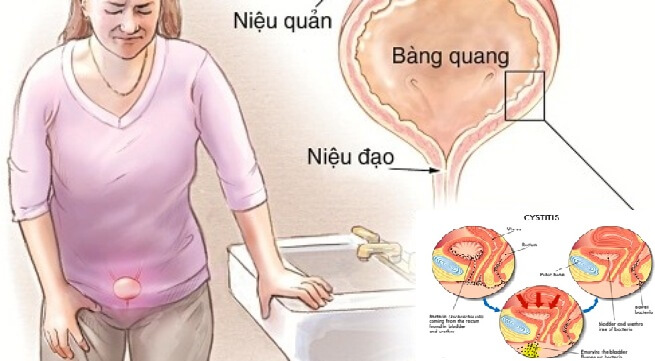 Viêm niệu đạo cấp