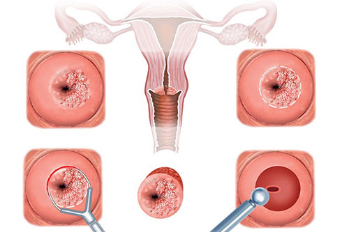 Tìm hiểu nguyên nhân gây naboth cổ tử cung