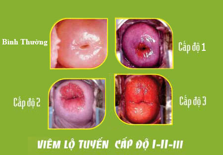 viem-lo-tuyen-co-tu-cung-3-cap-do